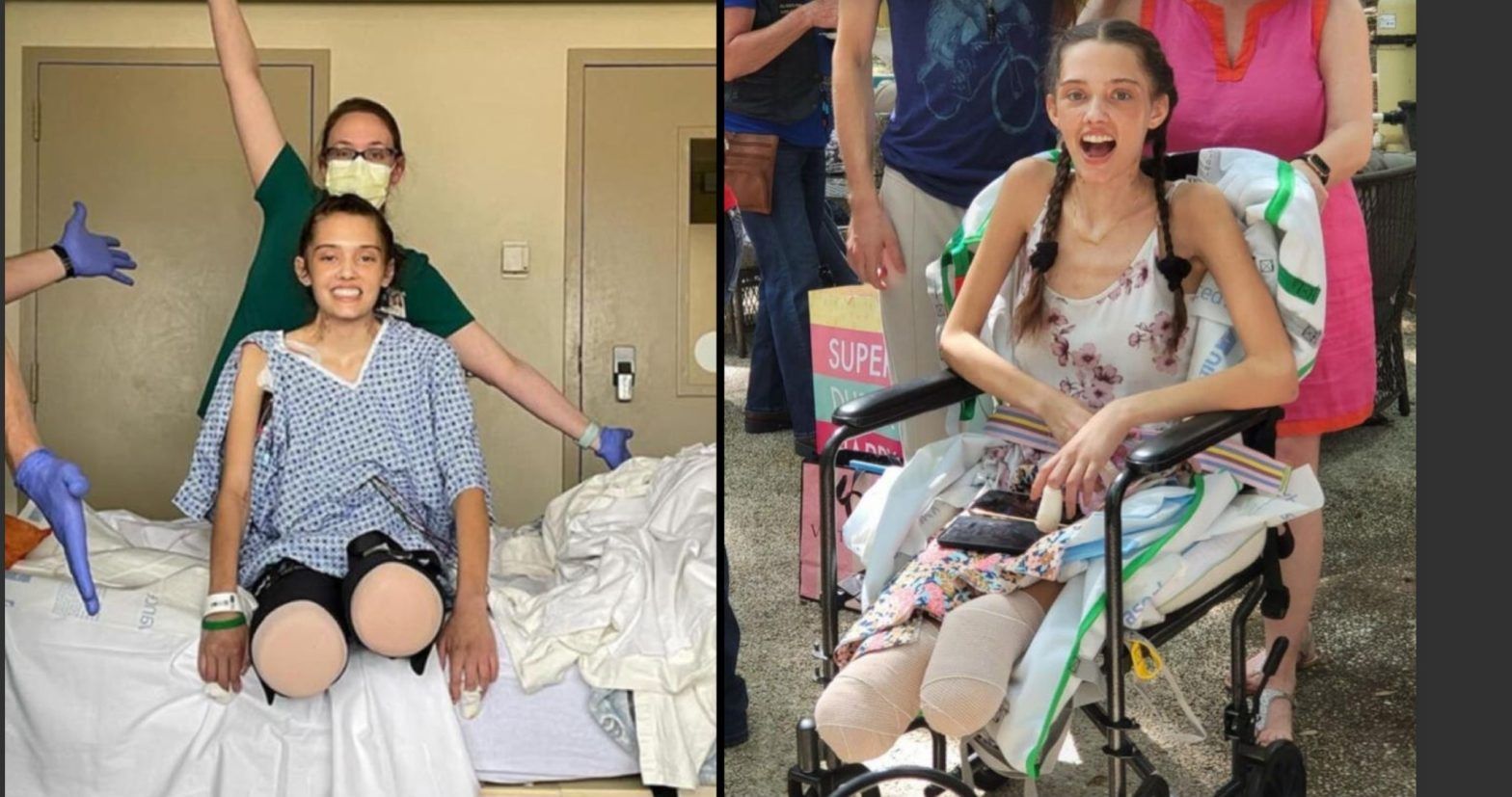 Young People who Suffered Blood Clots and Amputations after COVID-19 Vaccination are Being Lied to, and Media Uses Them to Lie to Us